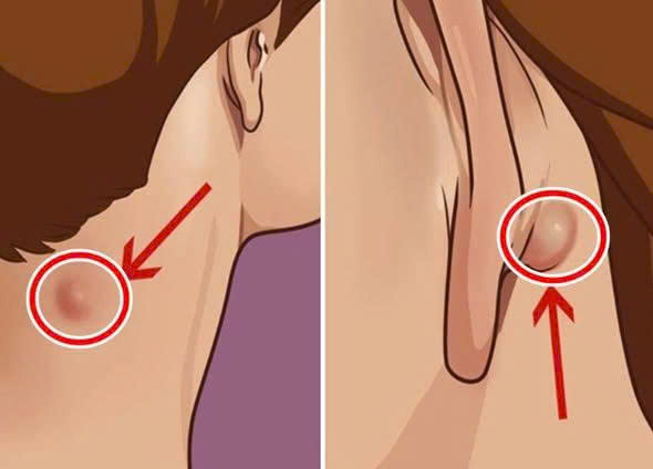 Người sắp bị UT thường có 3 dấu hiệu lạ ở cổ, có dù chỉ 1 bạn cũng cần đi khám khẩn cấp